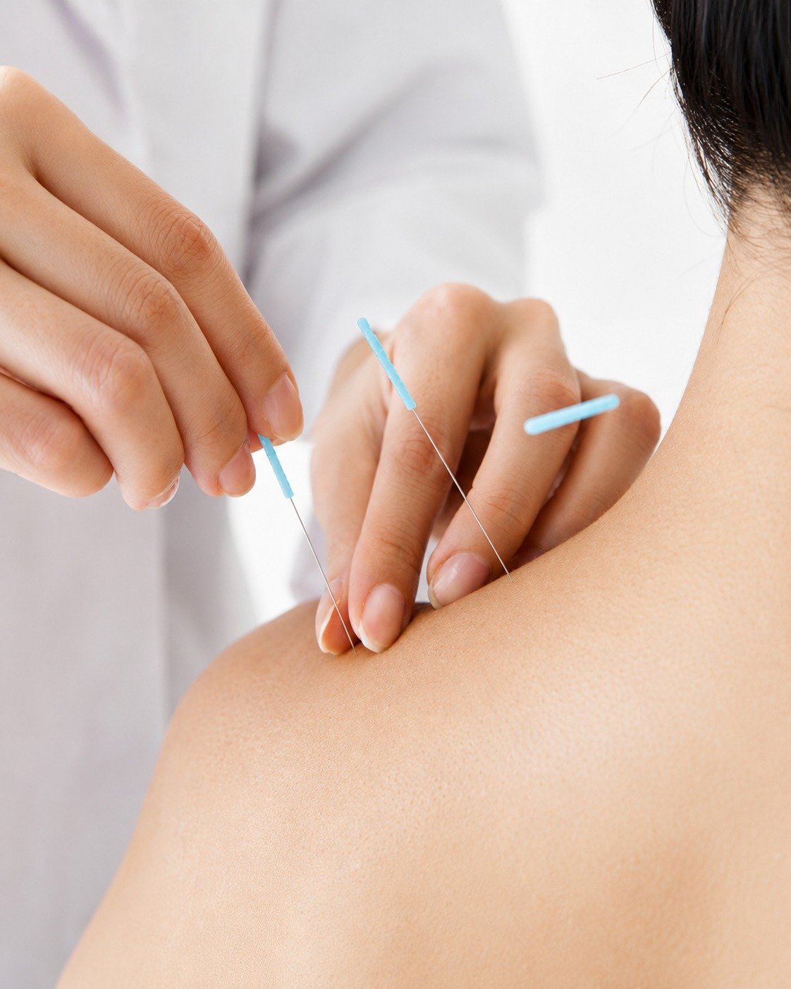 Dry needling
